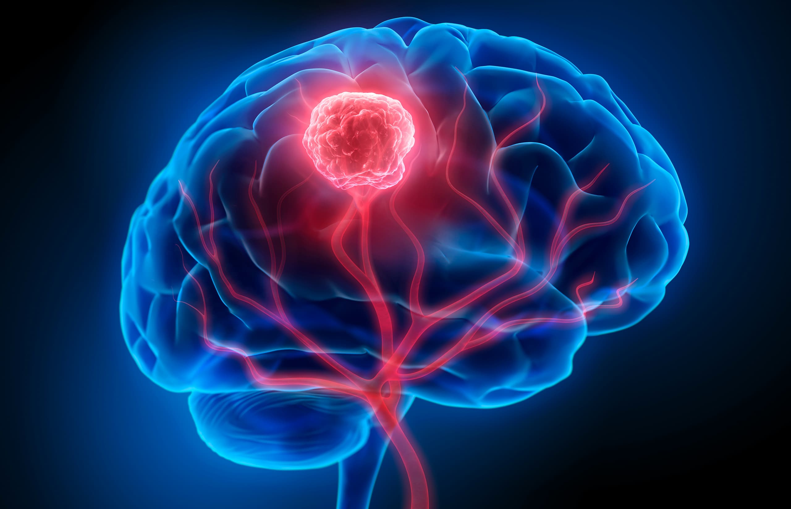 Brain Tumours Treatment Doctor in Lucknow