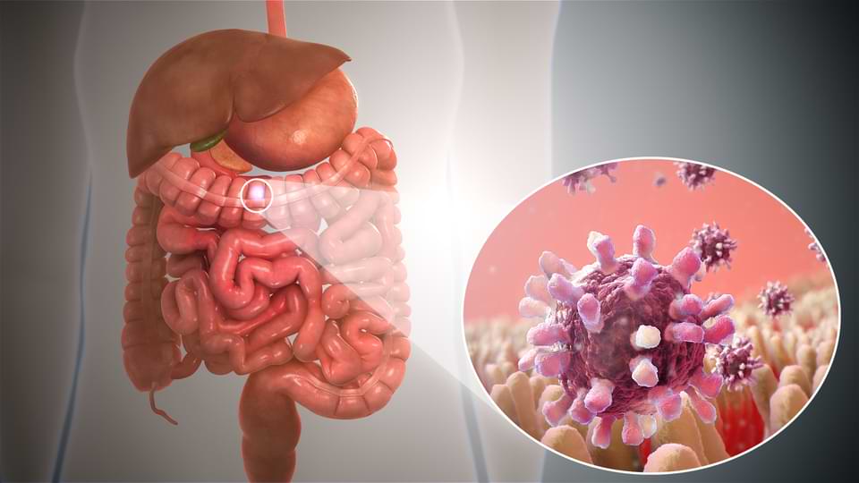 Gastrointestinal Cancer Treatment in Lucknow