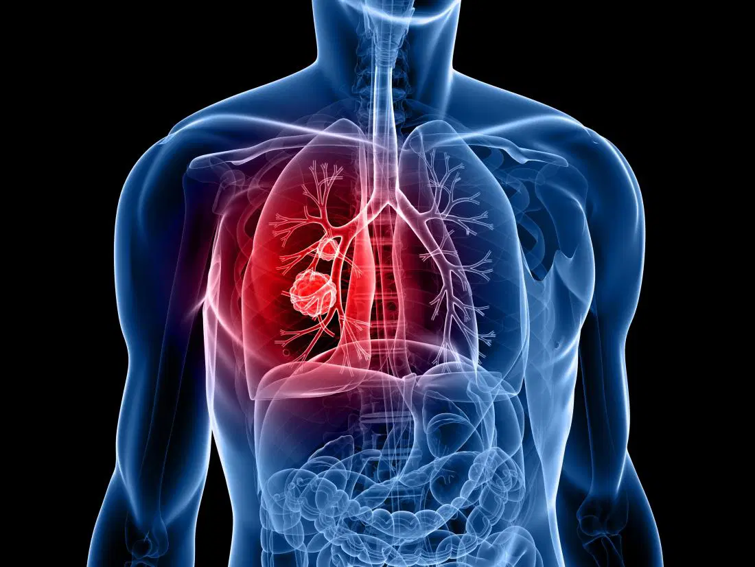 Lung Cancer Treatment in Lucknow