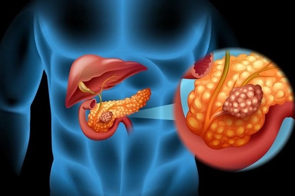 Pancreatic & Hepatobiliary Cancer Treatment in Lucknow