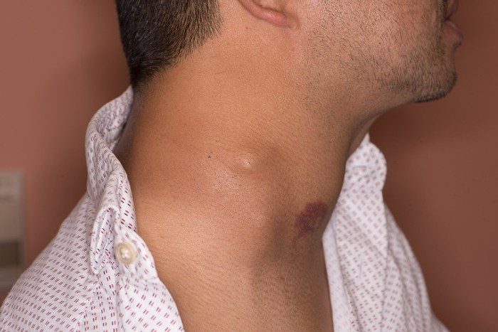 Thyroid Cancer Treatment in Lucknow